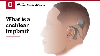 What is a cochlear implant  Ohio State Medical Center [upl. by Arther555]