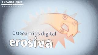 La osteoartritis digital erosiva [upl. by Nynnahs]