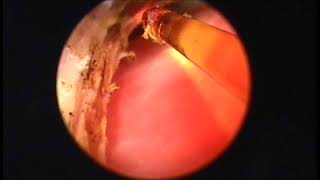 ENDOSCOPIA LASER IN URETERE ECTOPICO DEL CANE  LASER ENDOSCOPY IN ECTOPIC URETER OF THE DOG [upl. by Nicole6]