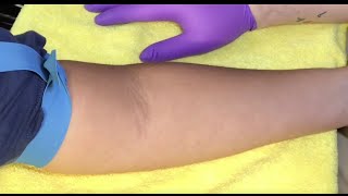 Tips For Locating Difficult Veins [upl. by Aitra]