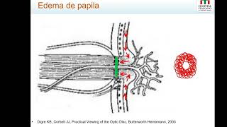 Edema de papila [upl. by Fachanan]