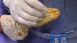 Bunion Screw Removal [upl. by Johnsson]