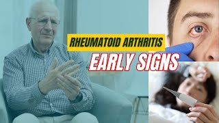 Rheumatoid Arthritis Symptoms You Should NOT Ignore [upl. by Idyak]