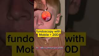 Fundoscopy with 20D  Mobile optometrist [upl. by Haywood]