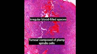 Histopathology of Aneurysmal Dermatofibroma dermpath dermatopathology pathology shorts [upl. by Adiaroz]