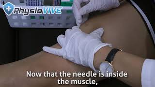 Dry Needling for Knee Pain [upl. by Shandy]