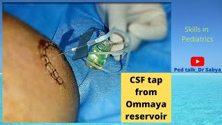 CSF tap procedure from Ommaya reservoir Ommaya tap decreasing RICT in Hydrocephalus [upl. by Sela]