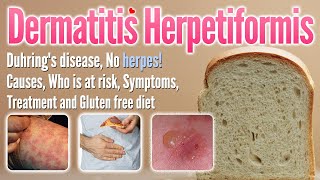 Dermatitis herpetiformis Causes Symptoms Treatment and glutenfree diet list  Duhring’s disease [upl. by Maighdlin]