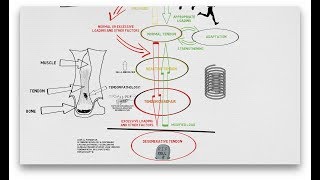 Tendinopathy Continuum and Update [upl. by Anigriv]