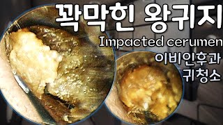 귀팡ASMR 꽉 막힌 왕귀지 Impacted cerumen removal이비인후과 귀청소 [upl. by Phebe990]