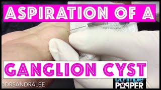 Aspiration of a ganglion cyst [upl. by Ynnig]