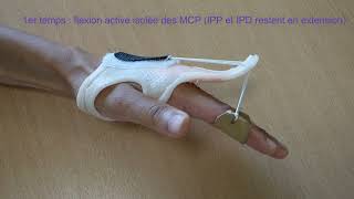 Suture tendon extenseur des doigts en zone 4  mobilisation précoce J  5 [upl. by Ysdnil]