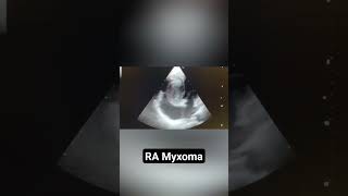 RA Myxoma in echo [upl. by Arytahs]