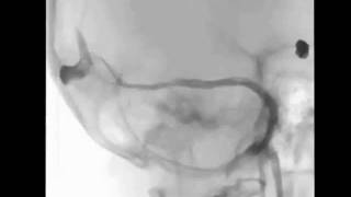 coiling aneurysm and transversus sinus angioplasty [upl. by Glass]