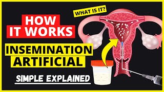 Artificial insemination in humans procedure  Intrauterine insemination IUI Fertility Treatment [upl. by Haldane486]