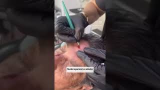 Las queratosis seborreicas  Dermarx Clinic Dr Mariano Marx [upl. by Vena255]