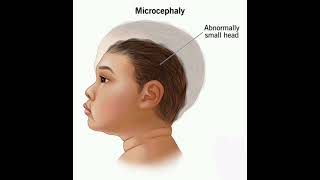 Microcephaly History mrcpch Clinical [upl. by Siegfried651]