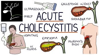 Understanding Acute Cholecystitis [upl. by Ellinger]