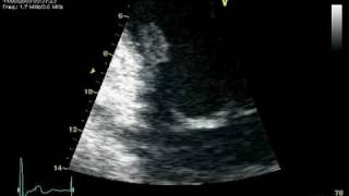 RUPTURE CHORDAE POSTEROMEDIAL PAPILARY MUSCLE  MR PROLAPSE [upl. by Havstad]