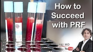 HOW TO EXCEED WITH PRF FACE INJECTIONSDr Rajani [upl. by Ivonne119]