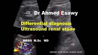 ULTRASOUND RENAL STONE DIFFERENTIAL DIAGNOSIS [upl. by Cnahc]