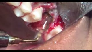 Piezotome assisted extraction of grossly decayed upper first molar [upl. by Iatnwahs]