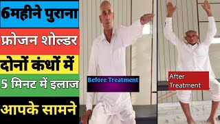 फ्रोजन शोल्डरFrozen shoulder treatment by dr Harendra choudhary physiotherapist [upl. by Anyal]