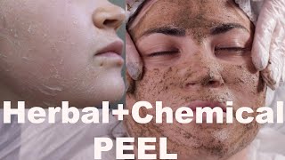 Herbal Skin Peel  Best Acne Treatment  Full procedurebefore amp after pictures [upl. by Odarnoc542]