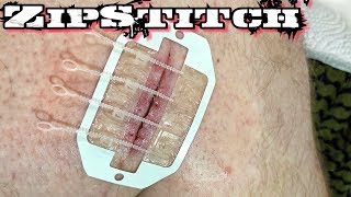 ZipStitch  Worlds Most Advanced Wound Closure Device [upl. by Recha]