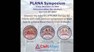 Cleft Presurgical Lip Nose and Alveolar Approximation PLANA  Alternative to Nasoalveolar Molding [upl. by Jump735]