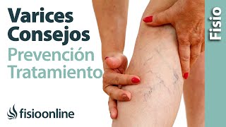 Mala circulación y varices  10 consejos para su prevención y tratamiento [upl. by Pirnot]