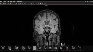 Is it MS or signs of high blood pressure and cholesterolMRI findings [upl. by Enivid127]