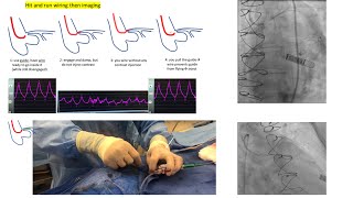 Aortoostial angiography and stenting tips and tricks  case illustrations Elias Hanna [upl. by Ybbed]