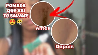 POMADA PARA ESPINHAS ACNE QUE SALVA EM POUCOS DIAS 😍 [upl. by Simeon]