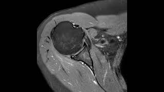 Tear of the posterior glenoid labrum and paralabral cyst [upl. by Trevorr315]