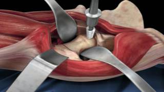 Direct Anterior Approach Hip Replacement [upl. by Alexander]