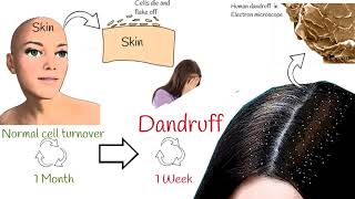 Dandruff explained in under 2 minutes Dandruff Causes and Treatment [upl. by Oster]