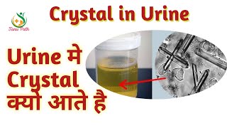 Triple Phosphate Crystal  Alkaline urine [upl. by Darken]