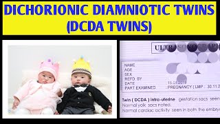 DCDA TWIN PREGNANCY IN HINDI DCDA TWINS MEANING DICHORIONIC DIAMNIOTIC TWINS  2023 twins [upl. by Nylqcaj]