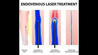 Operația de varice cu laser și recidiva  Varicele reapar dupa operatie Stefan Jianu  ProEstetica [upl. by Edmonds]