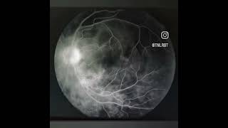 Fundus Fluorescein Angiography of APMPPE MEWDS angiography eye ffa [upl. by Ettesyl257]