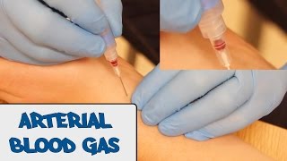 Arterial Blood Gas Sampling ABG  OSCE Guide old version  UKMLA  CPSA [upl. by Selig]