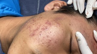 ACNE TREATMENT VU QUYNH MI Acne On Boys Chin 2024 [upl. by Jecon]