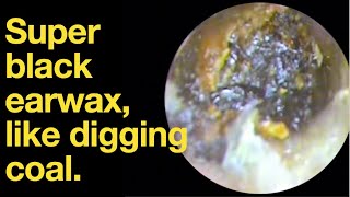 Super black earwax like digging coal ear wax removal  ear cleaning  ASMR  relaxation  relax [upl. by Middlesworth]