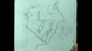 Cephalometric Analysis  Sagittal Analysis [upl. by Malamud405]