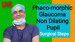 quotLivequot PHACOMORPHIC cataract REMOVAL IN A NON DILATING PUPIL Dr Kamal B kapoor [upl. by Arratahs]