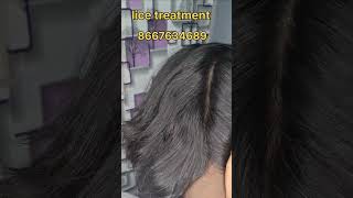 Lice treatment Available nits haircare headlice hair nitsremoval headliceremoval peenu eeru [upl. by Sadick65]