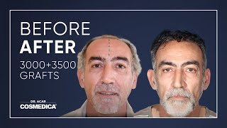 COSMEDICA DRACAR 3500 Grafts FUE Hair TransplantTurkeyIstanbul [upl. by Ahsilyt]