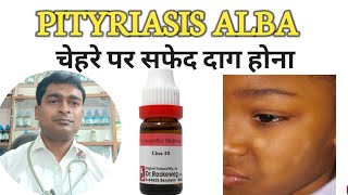 Treatment of Pityriasis albawhite patches of face how to remove white patches on children face [upl. by Wendie]