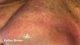 Blackheads Extractions and Acne Treatment on Daryl [upl. by Lamoureux905]